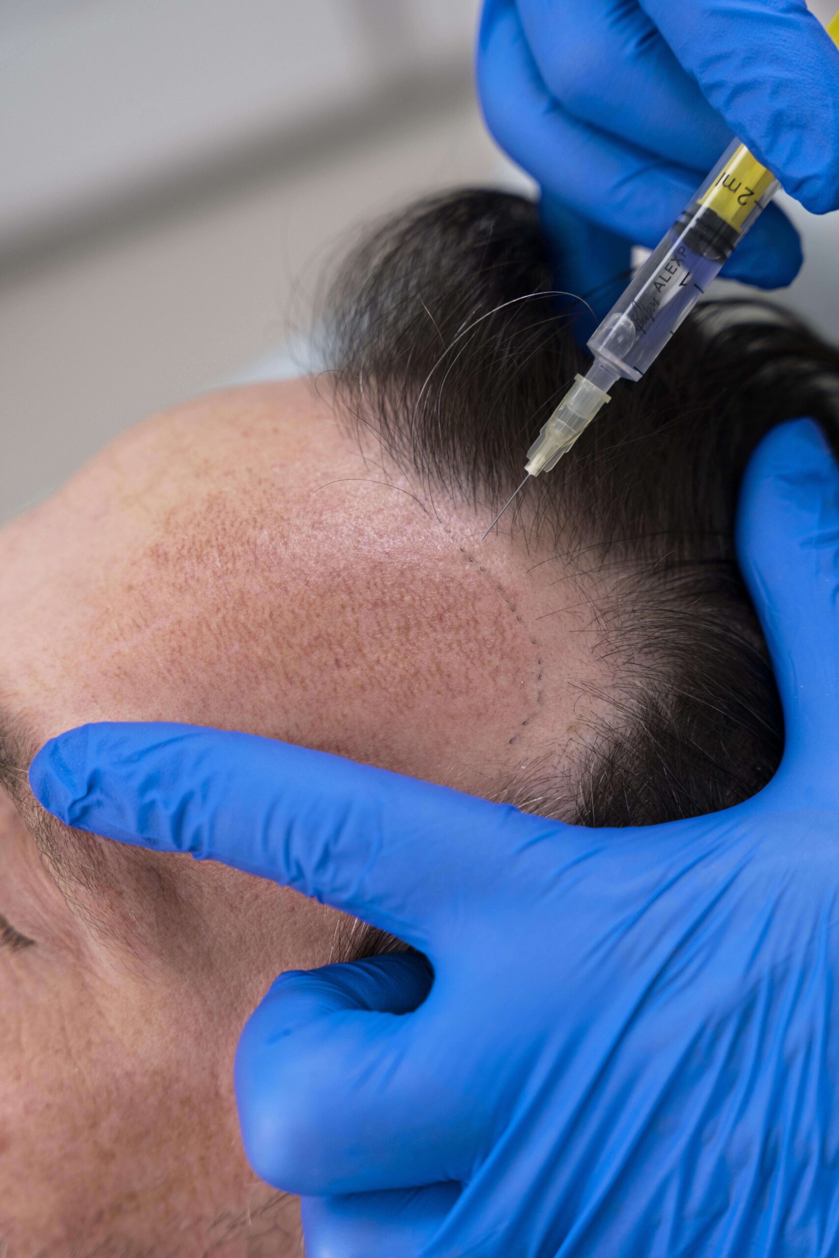 mesoterapia_hombres