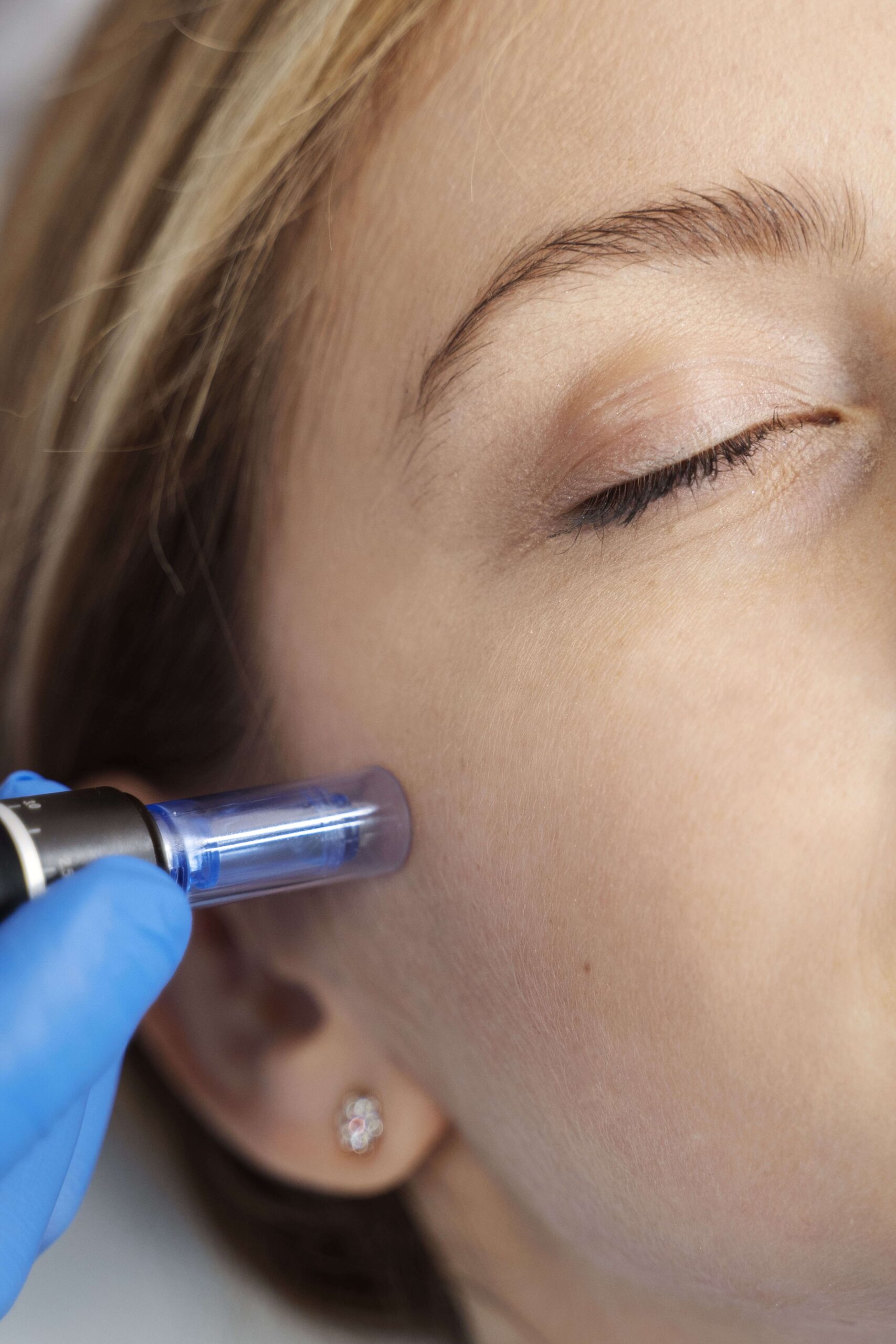 tratamiento facial_dermapen
